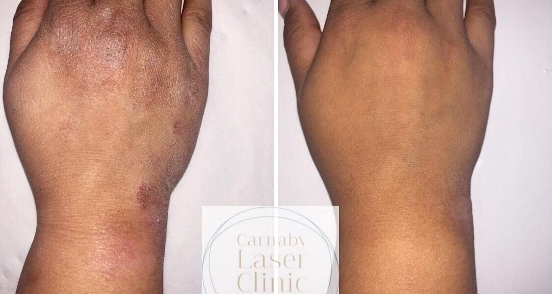 مركز The Carnaby Laser Clinic العيادة التجميلية الطبية الأفضل في الولايات المتحدة UK - صورة مميزة مركز The Carnaby Laser Clinic العيادة التجميلية الطبية الأفضل في الولايات المتحدة UK