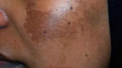 Dermanda Clinic إسم رائد في علاج الكلف بمختلف أنواعه