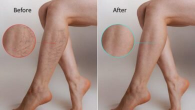 العيادة الطبية التجميلية Carnaby Laser Clinic and Academy تُعالج الأوردة العنكبوتية بواسطة الليزر